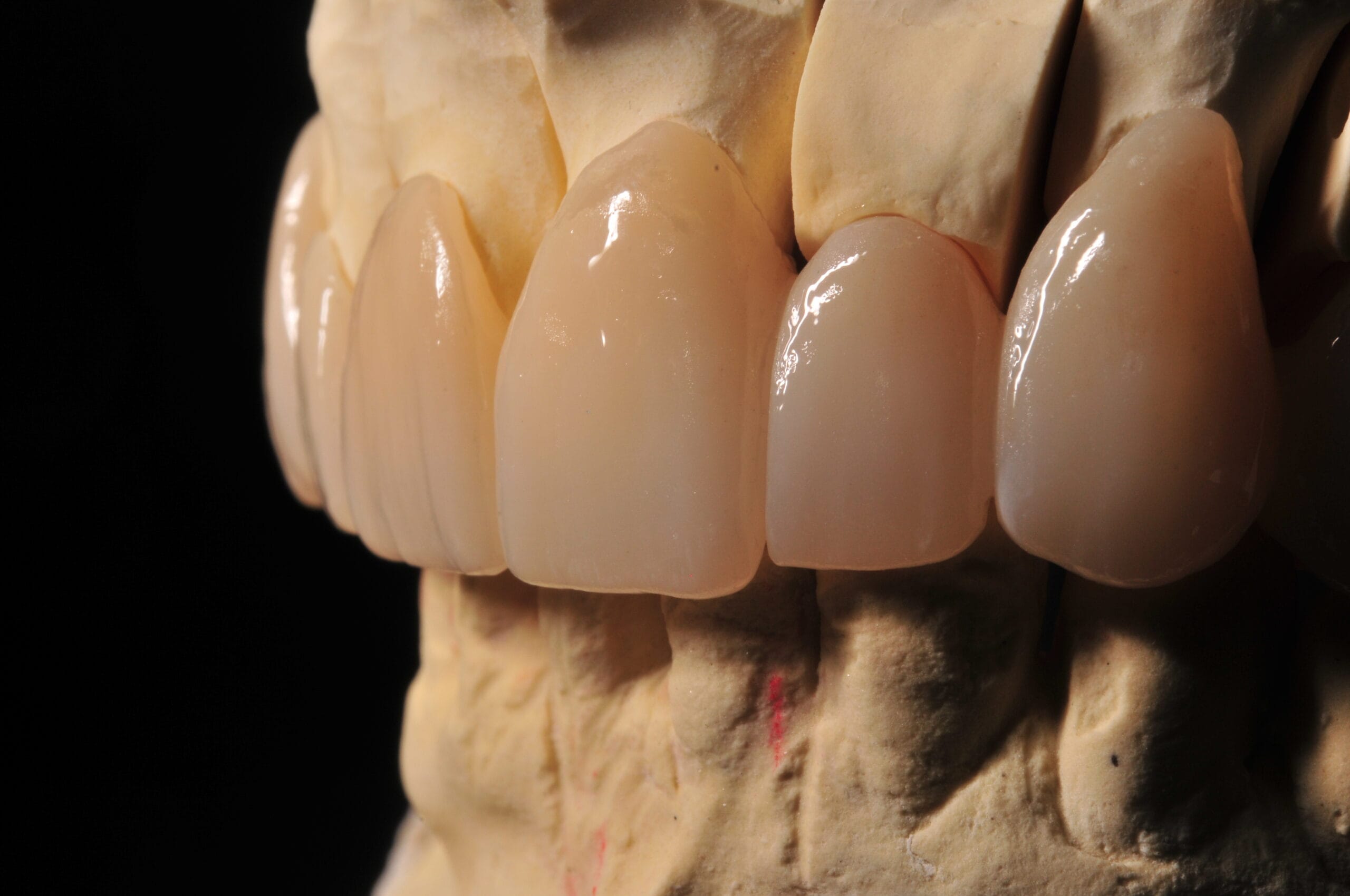 Corone dentali in zirconia realizzate dal Laboratorio Odontotecnico Massimo Sargentini a Sesto San Giovanni, con rifinitura estetica e adattamento perfetto.