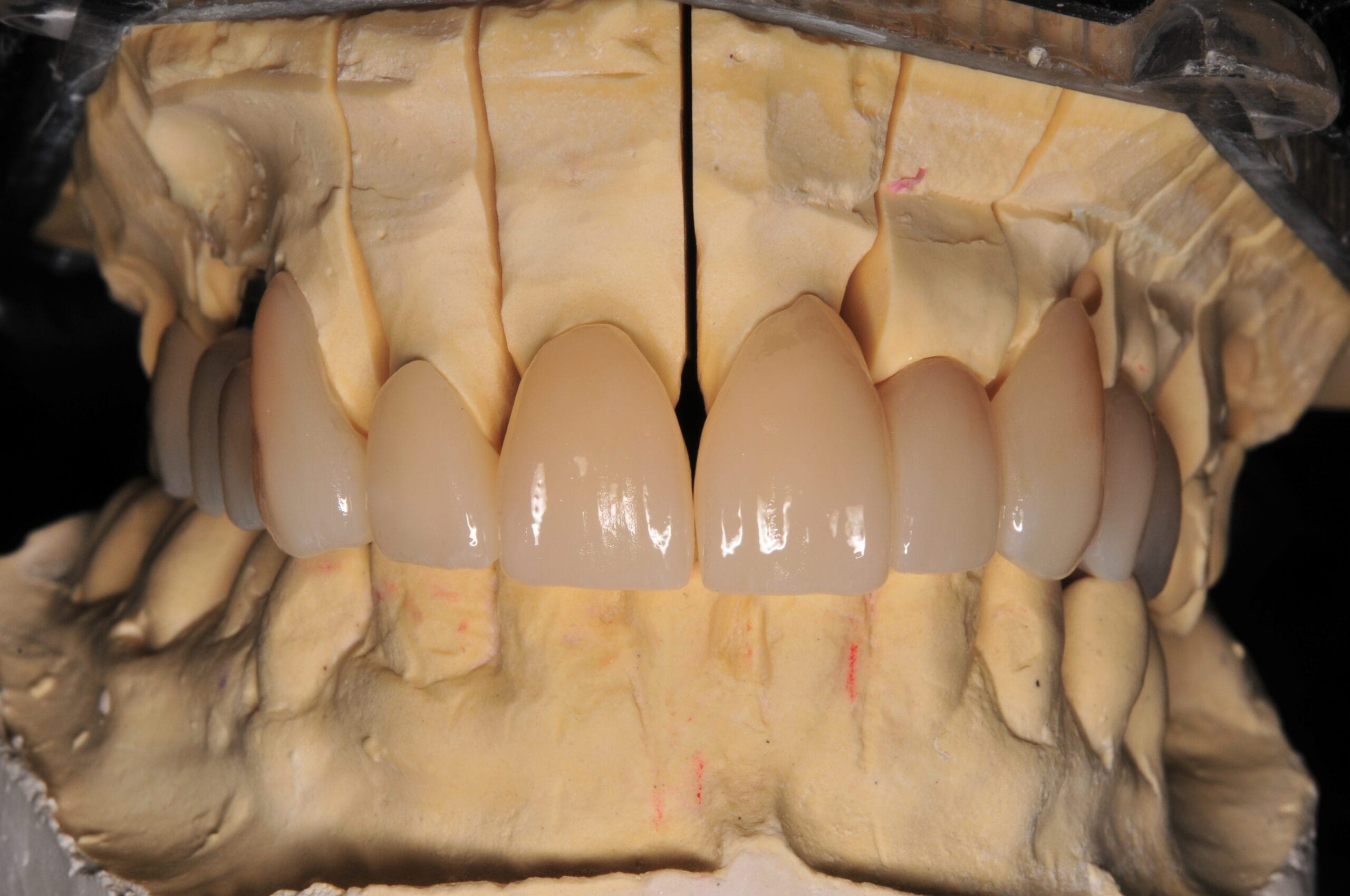 Corone in disilicato di litio prodotte dal Laboratorio Odontotecnico Massimo Sargentini, progettate per un risultato estetico di massima traslucenza.