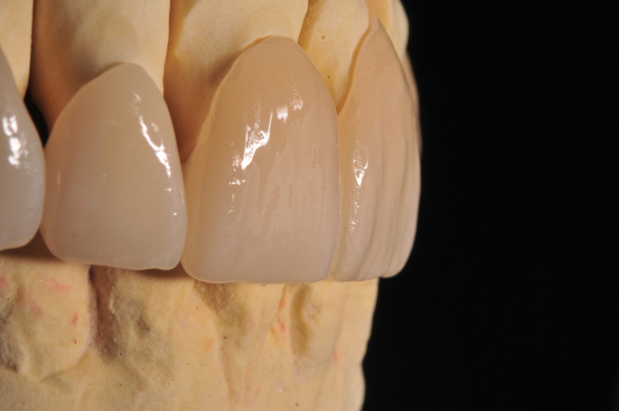 Dettaglio laterale di corone dentali in zirconia e disilicato, realizzate dal Laboratorio Odontotecnico Massimo Sargentini con finitura estetica personalizzata.