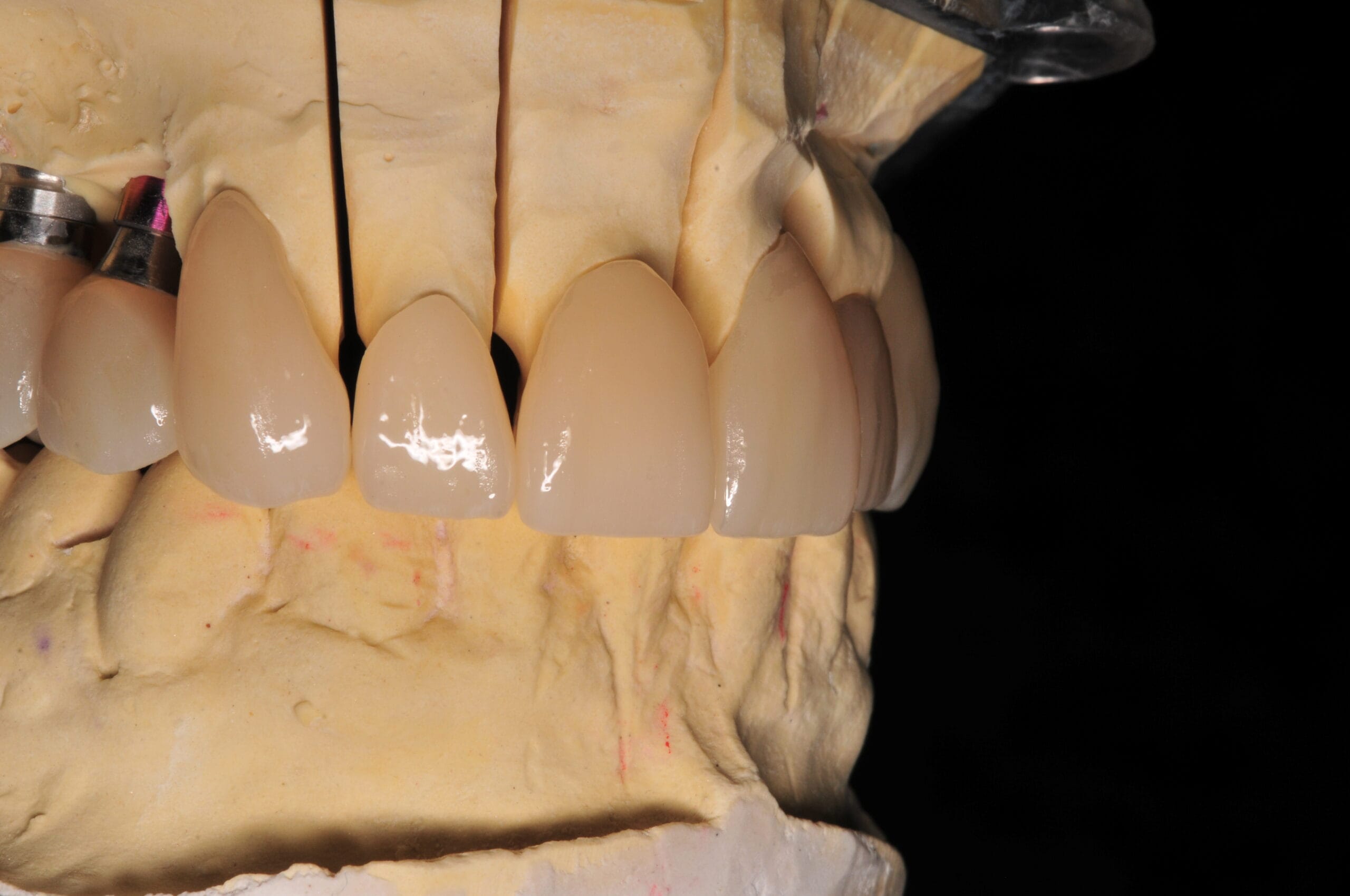 Vista frontale delle corone dentali in zirconia realizzate dal Laboratorio Odontotecnico Massimo Sargentini, esempio di equilibrio tra estetica e funzionalità.