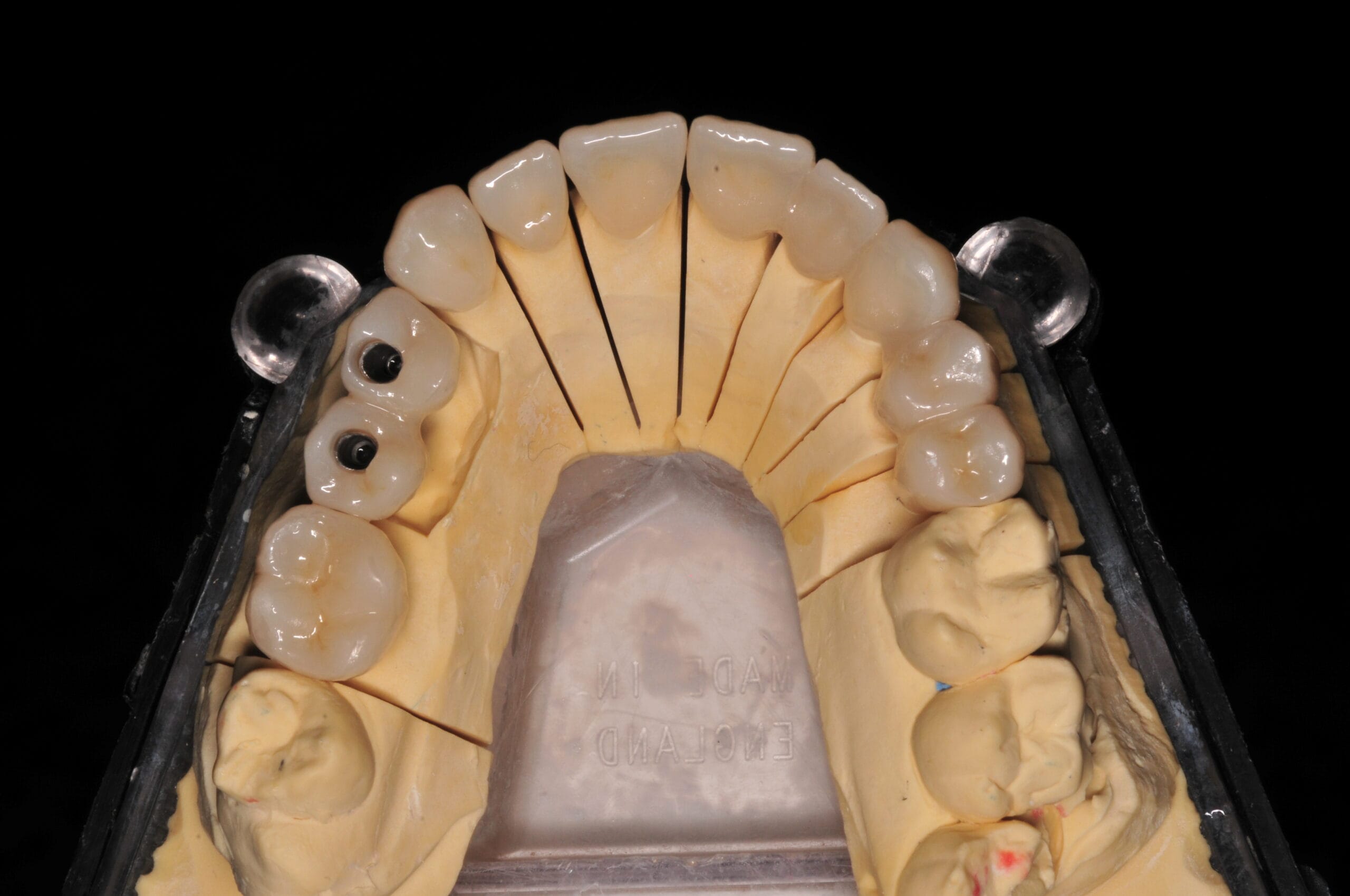 Vista occlusale delle corone in zirconia realizzate dal Laboratorio Odontotecnico Massimo Sargentini, con struttura interna di supporto e adattamento preciso.