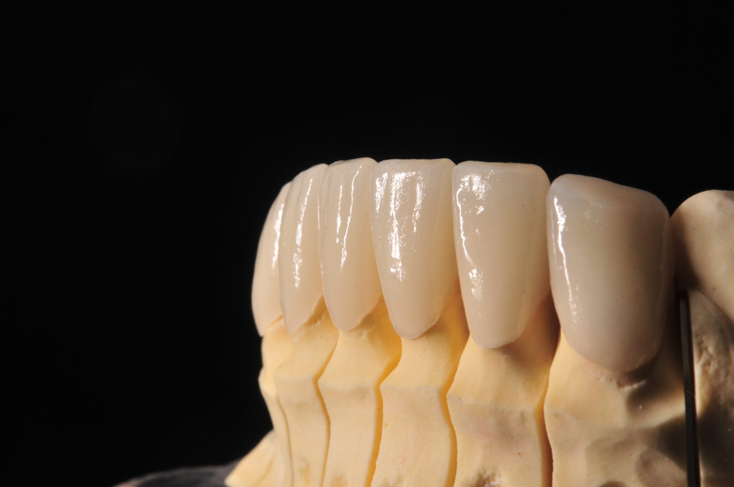Dettaglio ravvicinato delle faccette dentali in disilicato di litio, rifinite a mano dal Laboratorio Odontotecnico Massimo Sargentini.