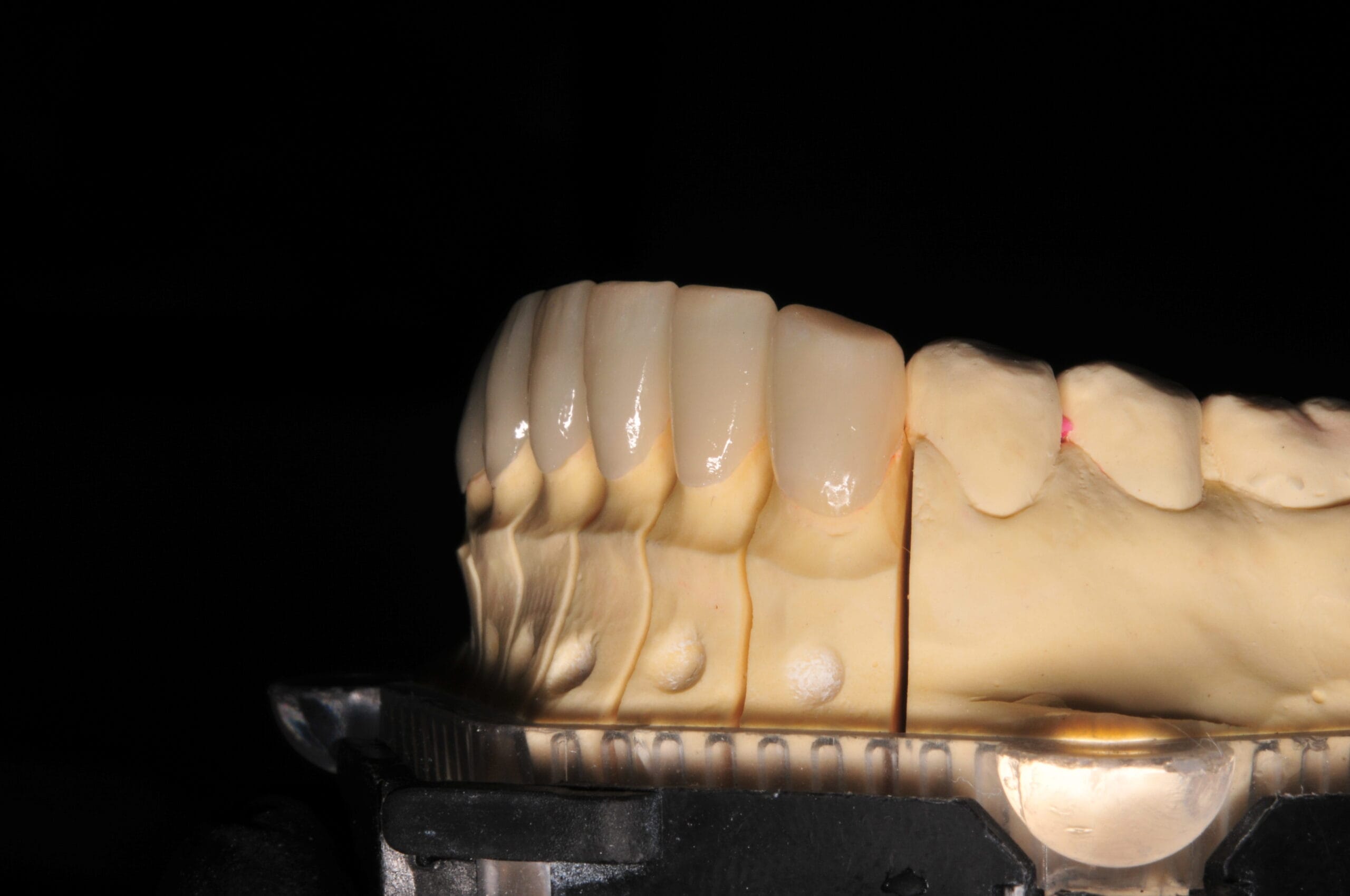 Vista frontale sinistra delle faccette dentali in disilicato di litio realizzate dal Laboratorio Odontotecnico Massimo Sargentini.