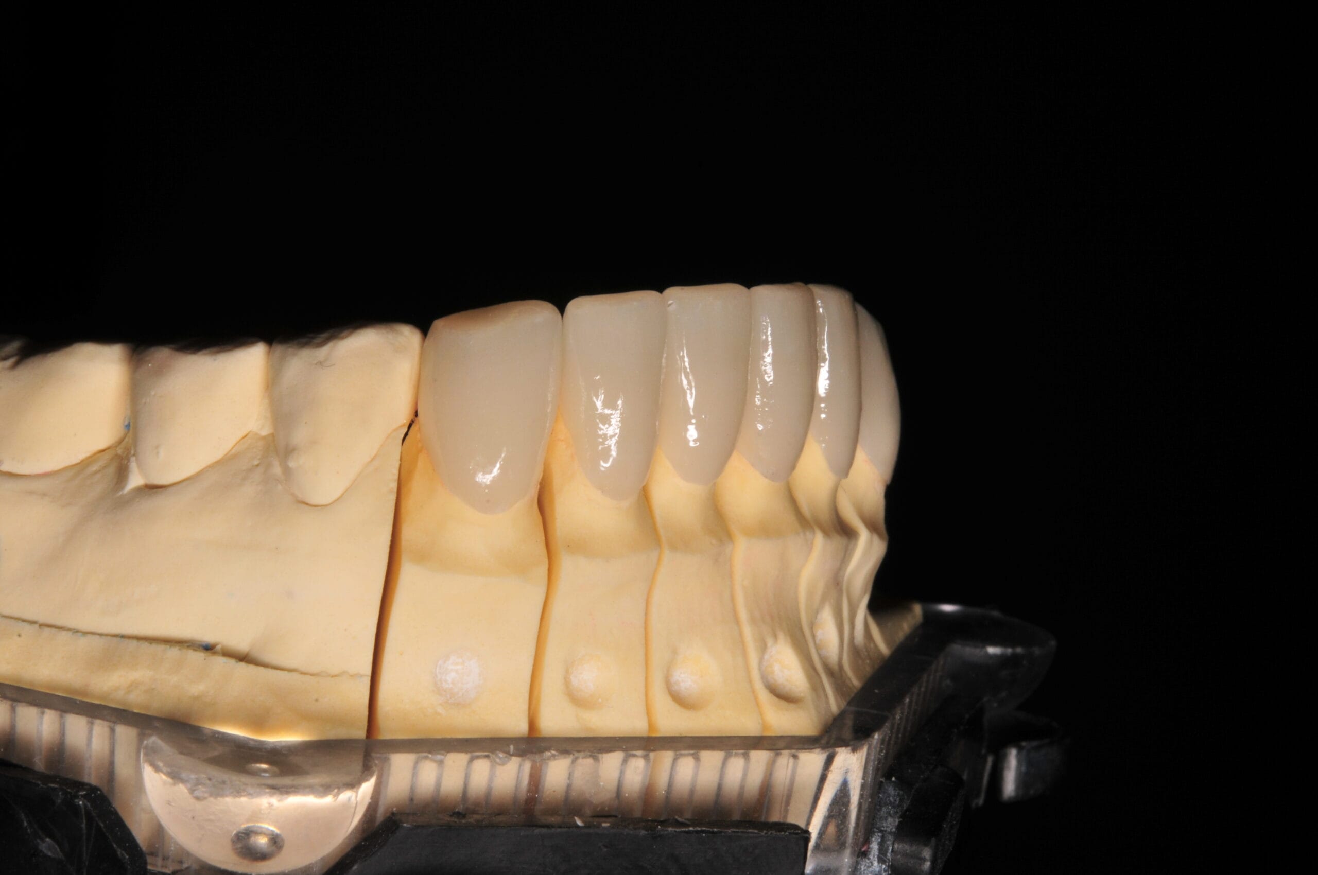 Vista laterale destra delle faccette dentali in disilicato di litio, prodotte dal Laboratorio Odontotecnico Massimo Sargentini.