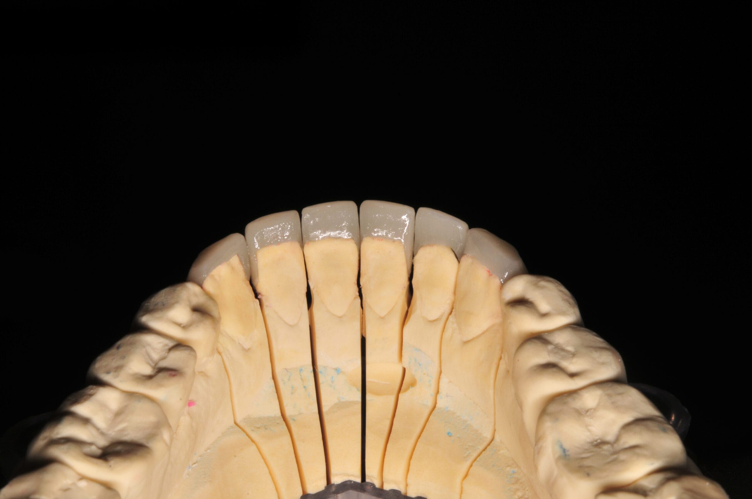 Vista occlusale delle faccette dentali in disilicato di litio realizzate dal Laboratorio Odontotecnico Massimo Sargentini a Sesto San Giovanni.