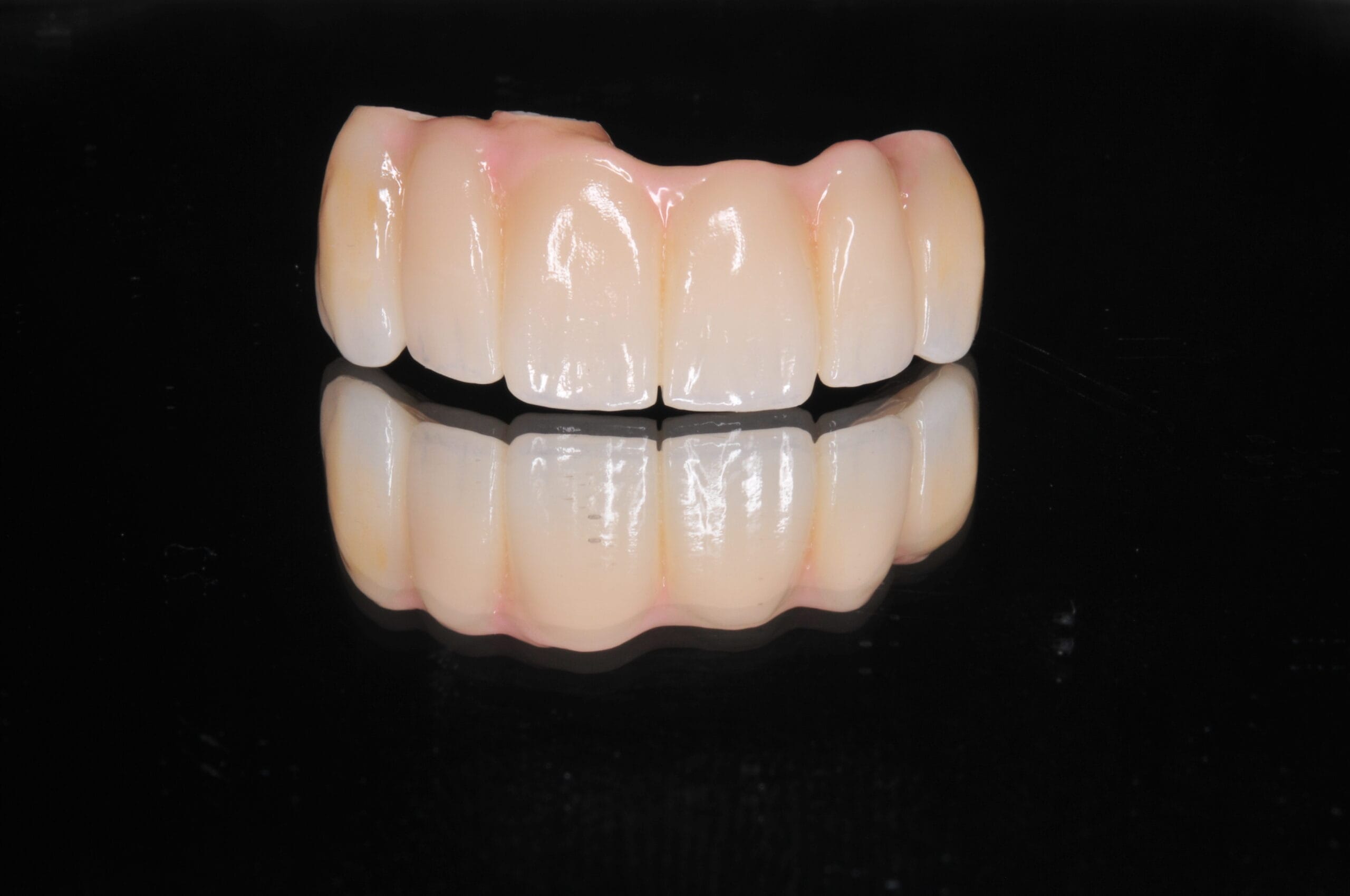 Ponte dentale in zirconia con gengiva estetica realizzato dal Laboratorio Odontotecnico Massimo Sargentini a Sesto San Giovanni.