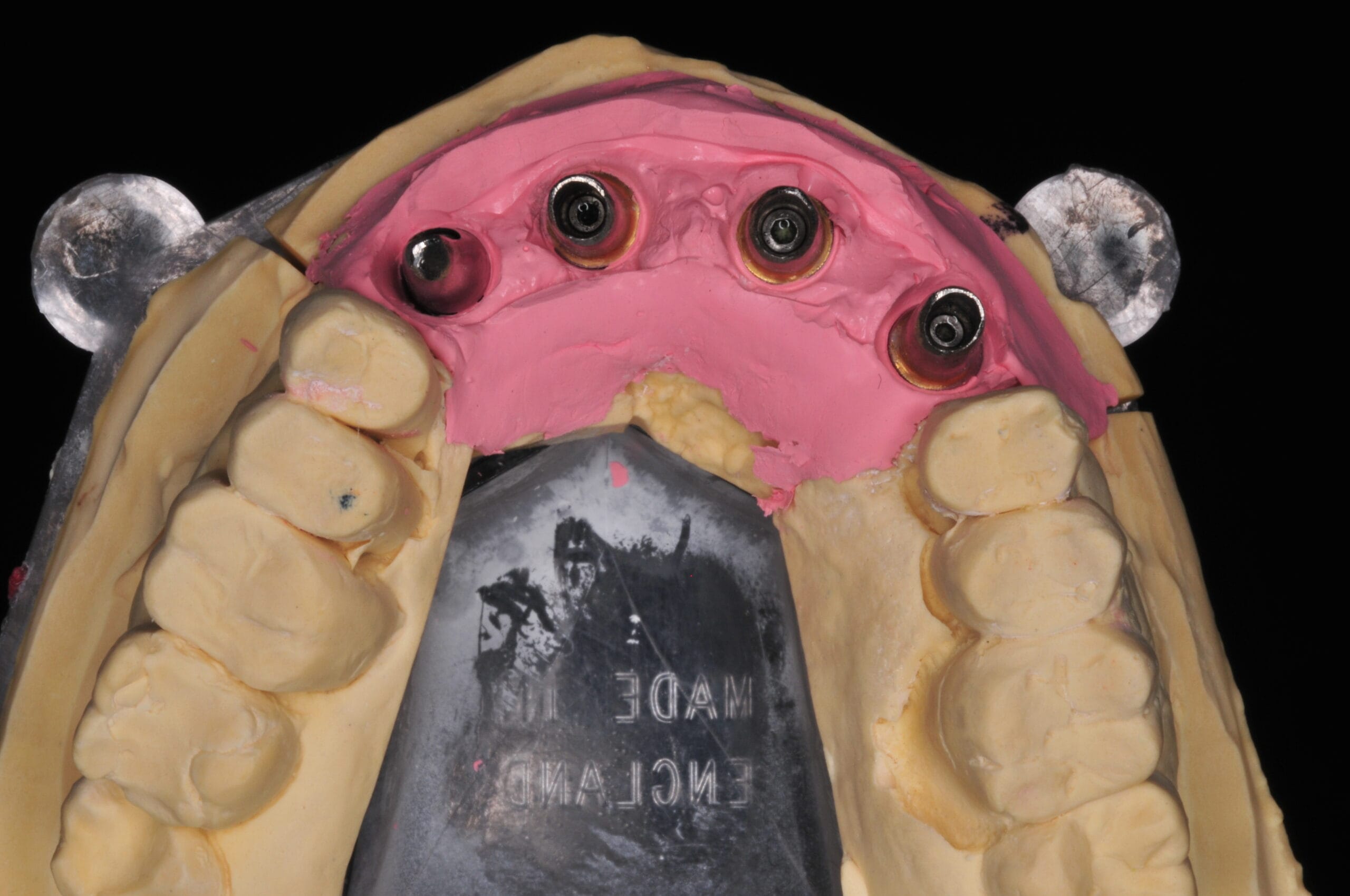 Vista interna della struttura implantare di un ponte dentale metallo-ceramico, lavorazione del Laboratorio Odontotecnico Massimo Sargentini.