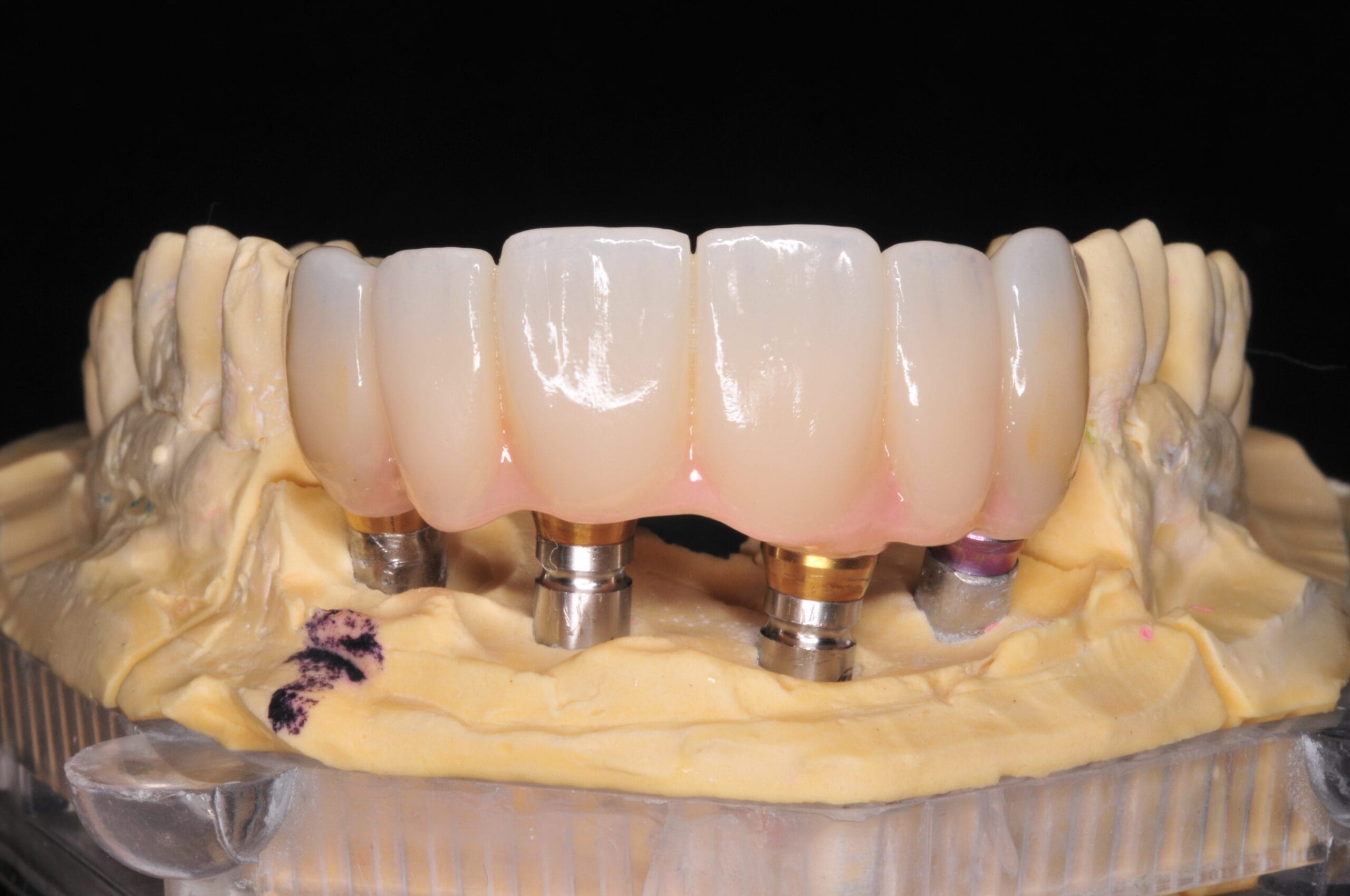 Ponte dentale in zirconia fissato su impianti, lavorazione del Laboratorio Odontotecnico Massimo Sargentini con dettagli estetici naturali.