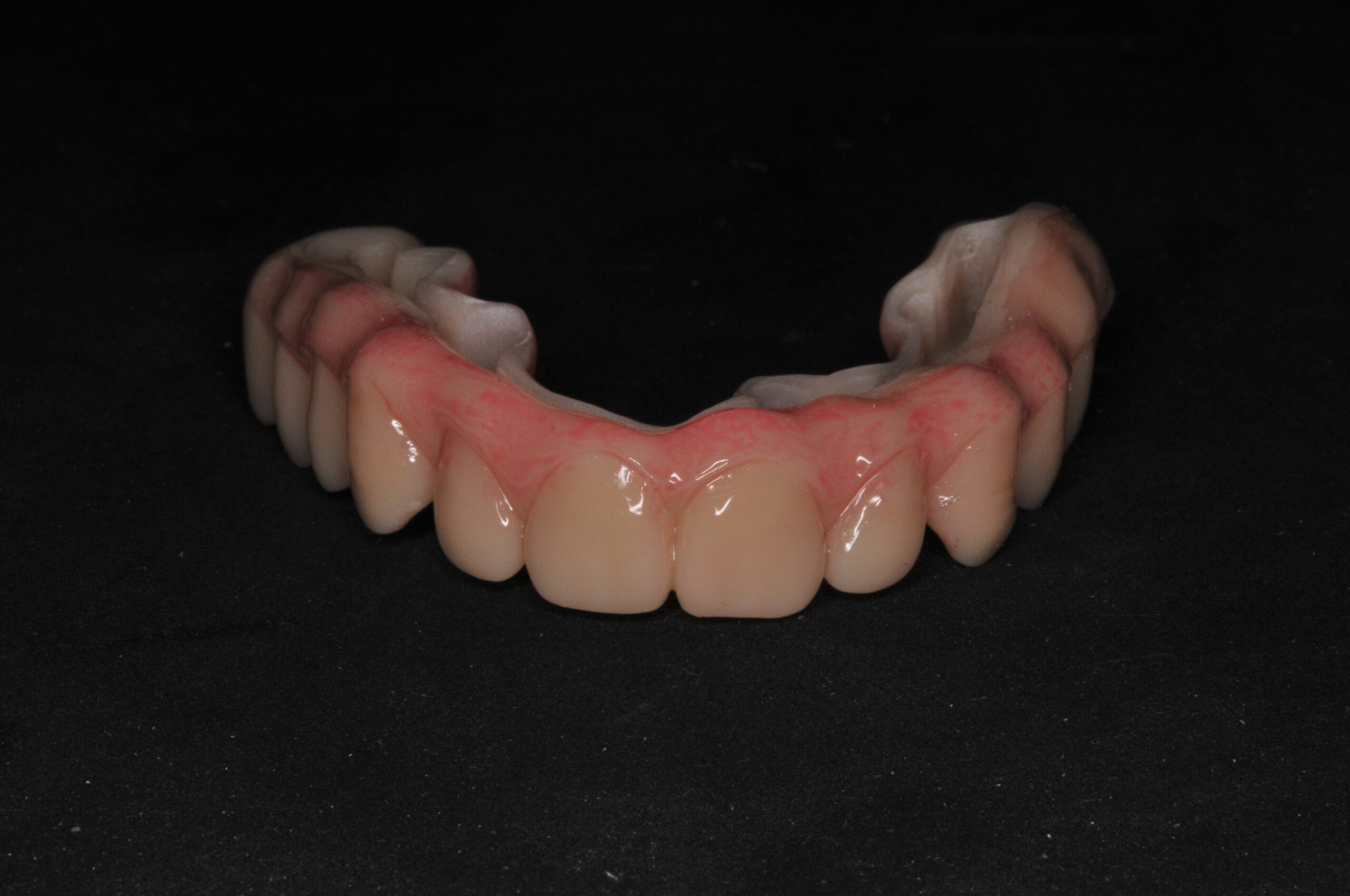 Protesi di Toronto completa in ceramica con gengiva estetica, rifinita a mano dal Laboratorio Odontotecnico Massimo Sargentini.