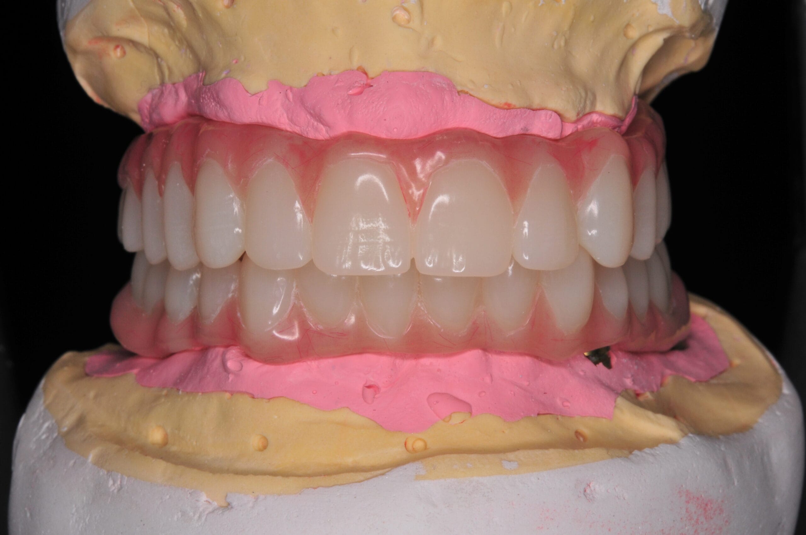 Vista frontale della protesi di Toronto su impianti, prodotta dal Laboratorio Odontotecnico Massimo Sargentini con materiali biocompatibili e rifinitura artigianale.