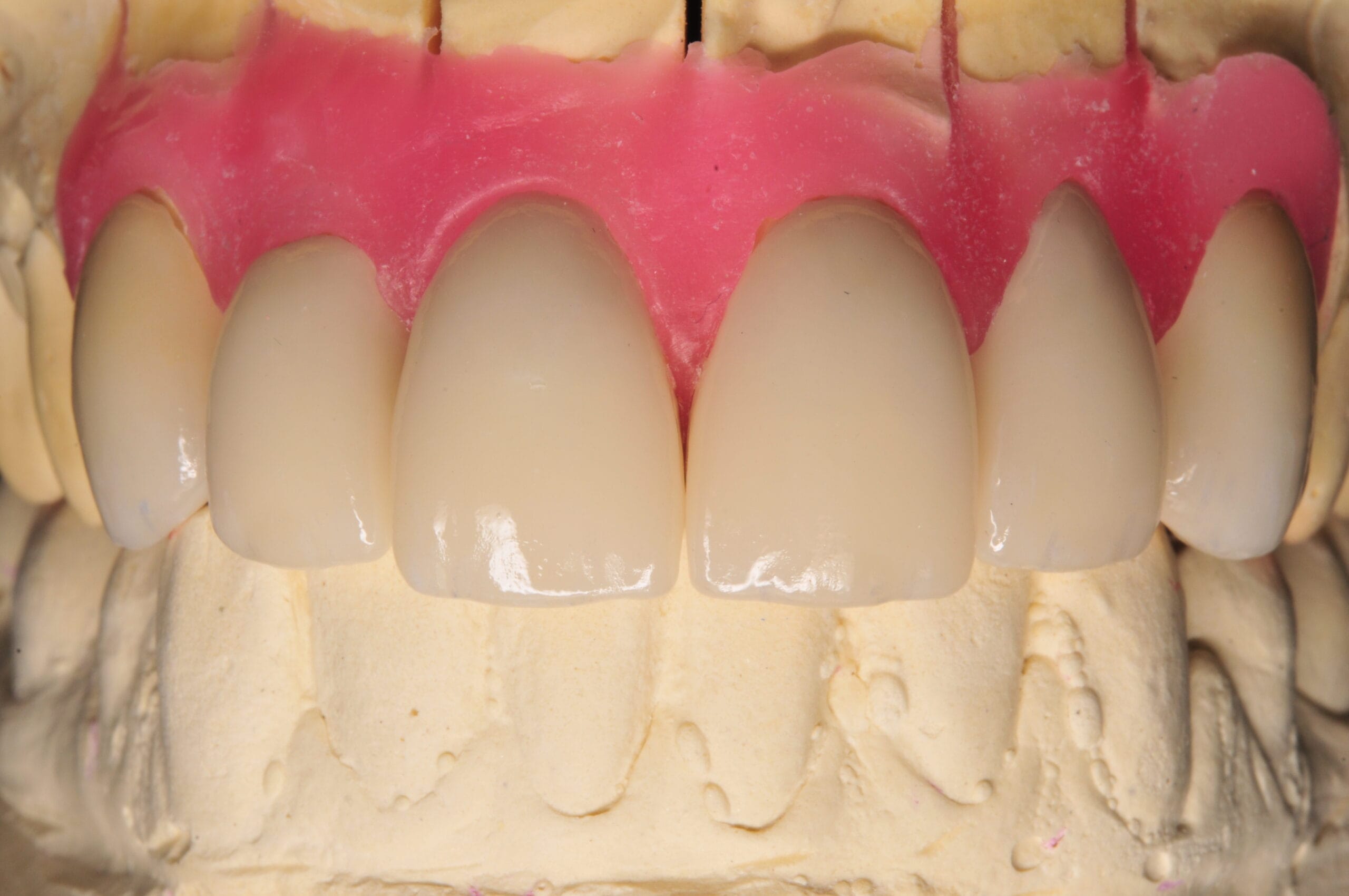 Protesi di Toronto su impianti realizzata dal Laboratorio Odontotecnico Massimo Sargentini a Sesto San Giovanni, con gengiva estetica e denti anteriori in ceramica.