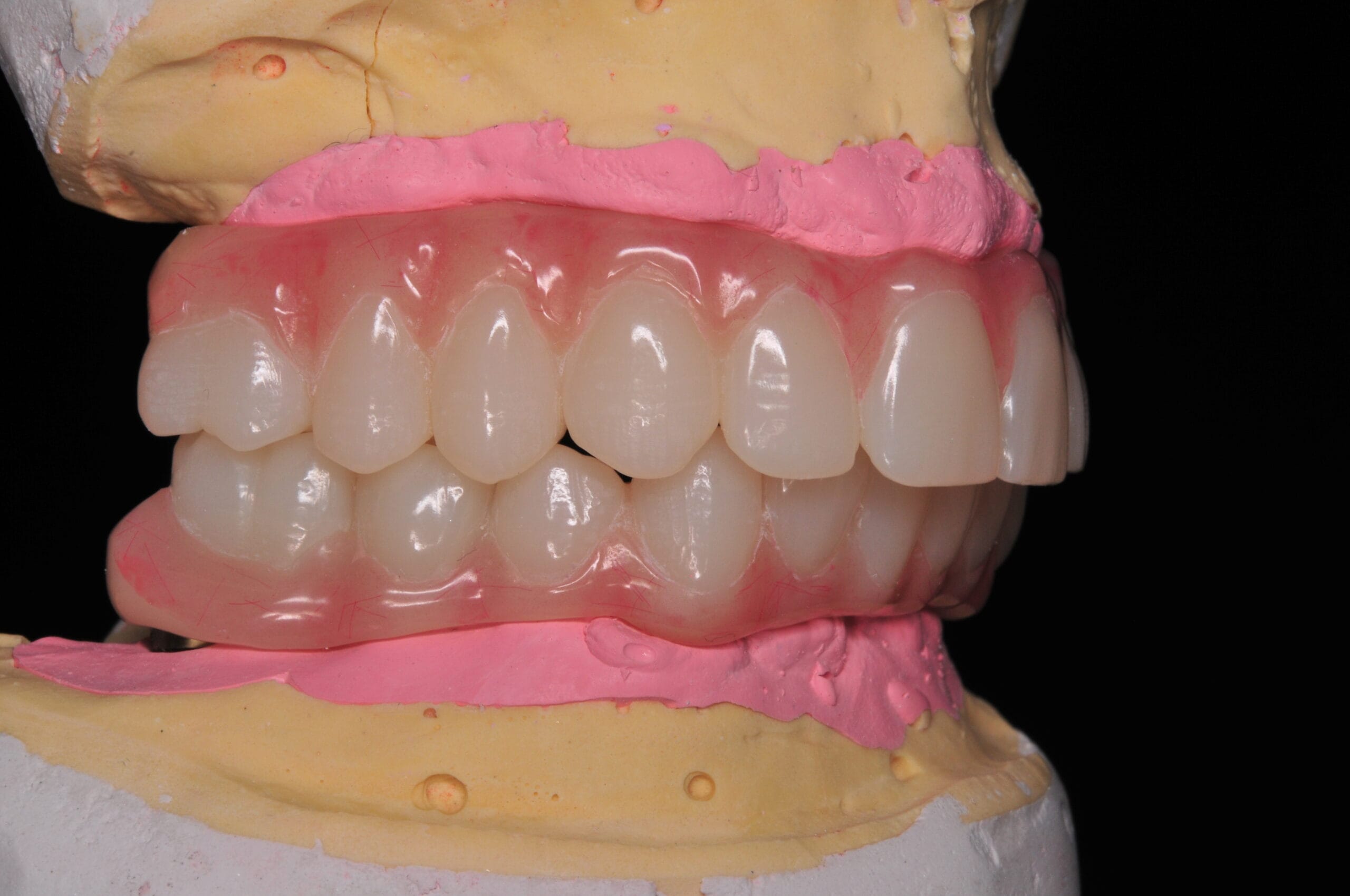 Protesi di Toronto su impianti multipli realizzata dal Laboratorio Odontotecnico Massimo Sargentini a Sesto San Giovanni, con gengiva estetica in resina rosa e denti in ceramica.