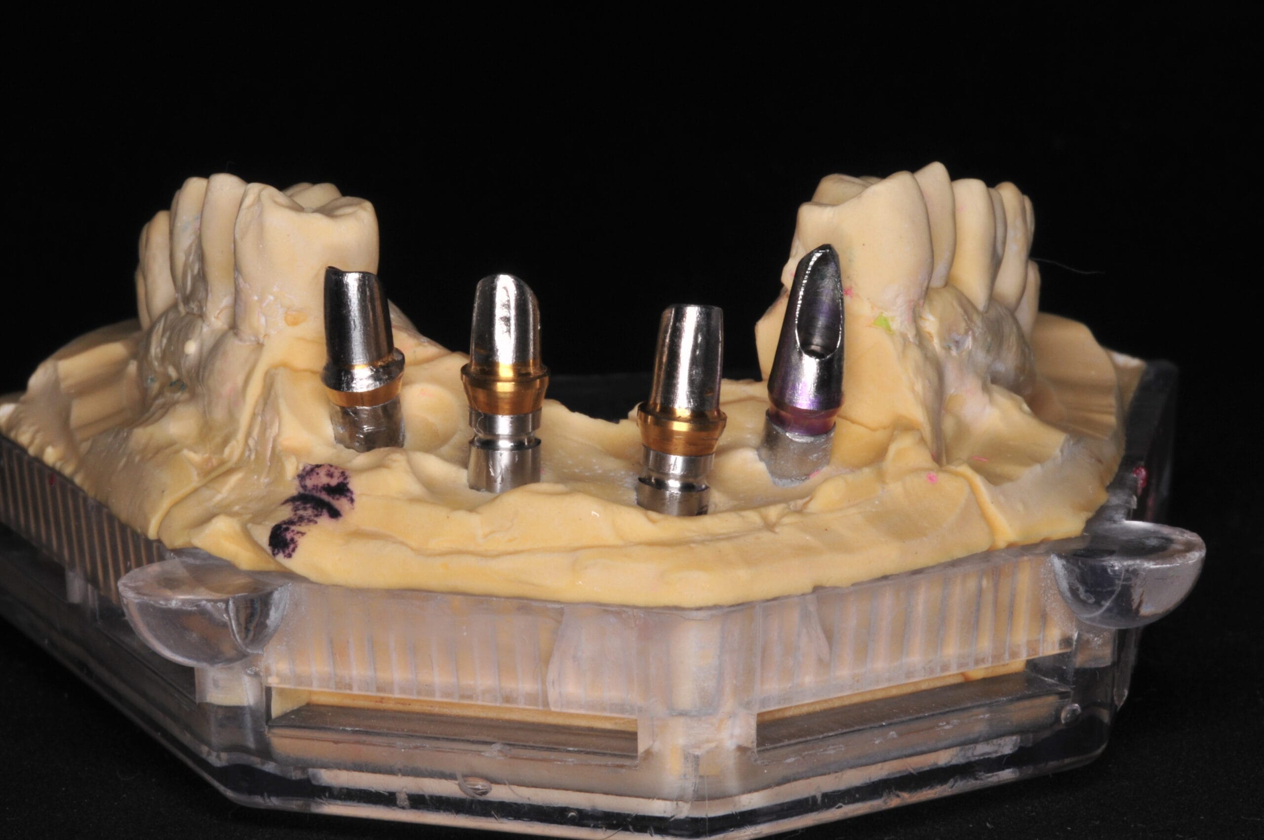 Struttura in metallo-ceramica per ponte dentale su impianti, realizzata con tecnologia CAD/CAM dal Laboratorio Odontotecnico Massimo Sargentini.